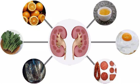 怎樣預防腎結石的發生